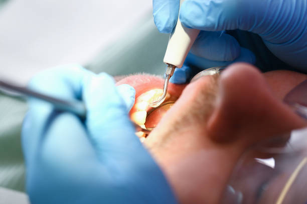 Best Emergency Treatment for Dental Infections or Abscesses in Pitola, CA