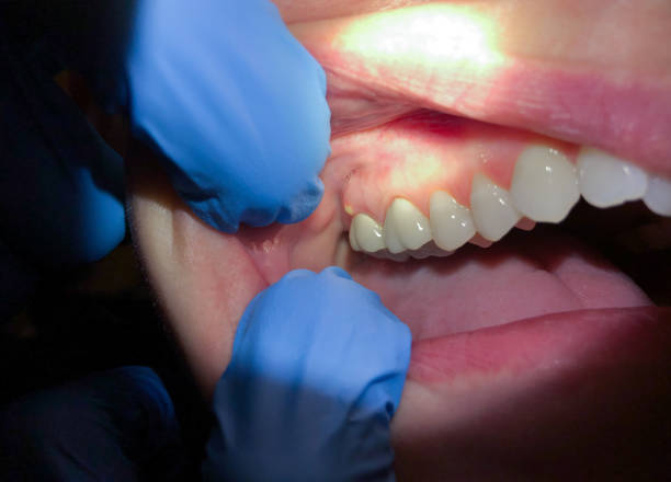 Best Emergency Treatment for Dental Infections or Abscesses in Pitola, CA